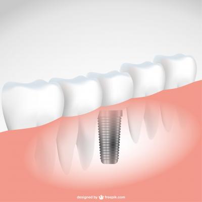 implant dentaire paris 18